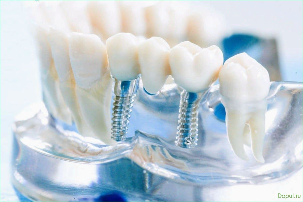 Избавьтесь от проблем с зубами с помощью правильного выбора зубного протеза: советы экспертов