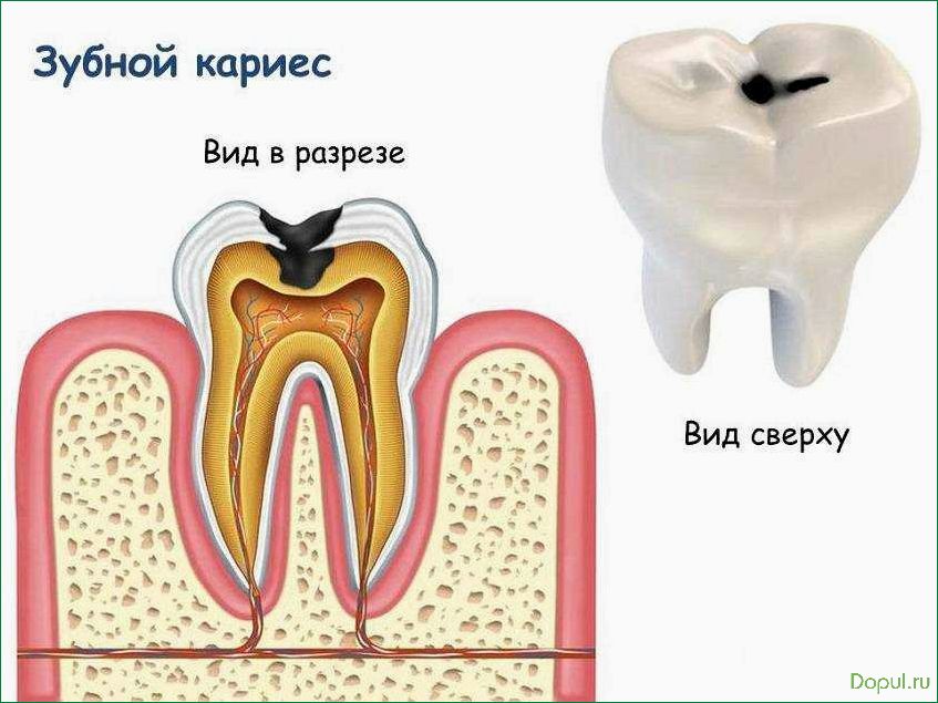 Кариес зуба: симптомы, лечение и профилактика