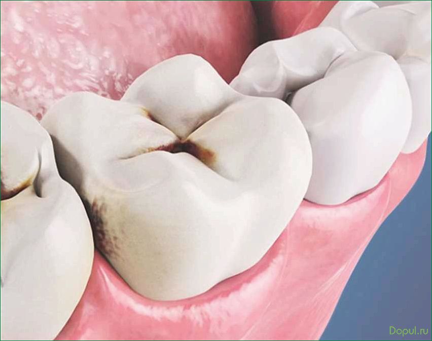 Кариес зуба: симптомы, лечение и профилактика